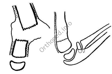 Principes de réduction d'une fracture supra-condylienne