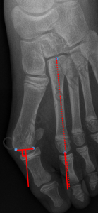 Mesure de l'angle DM2AA