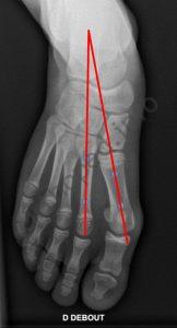 Mesure de l'angle M1-M2