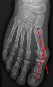 Mesurer l'angle M1-P1 qui est l'angle de l'hallux valgus