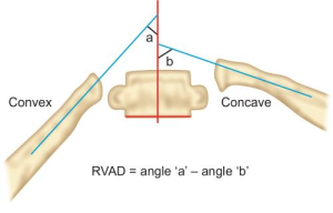 Le Rib Vertebral Angle Difference de Mehta