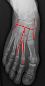 Comment mesurer le métatarsus adductus?