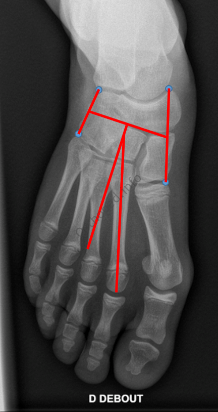 Angle de Métatarsus Adductus