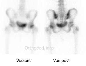 Scintigraphie préopératoire. Epiphysiolyse de hanche gauche à grand déplacement.