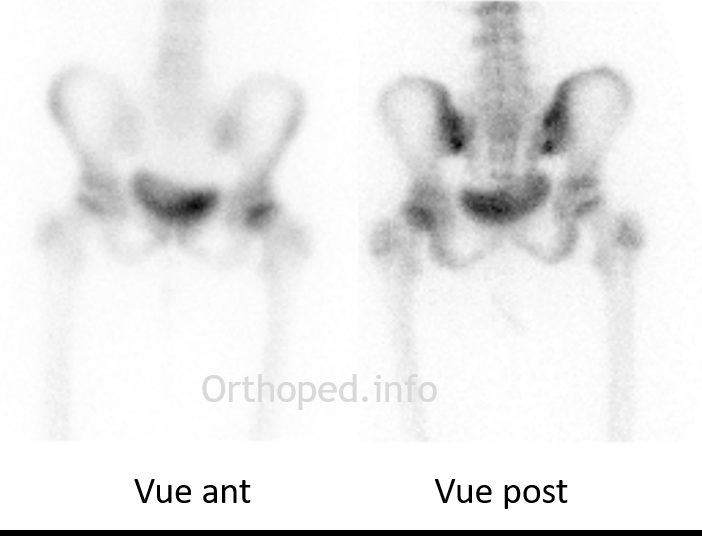 Scintigraphie préopératoire. Epiphysiolyse de hanche gauche à grand déplacement.