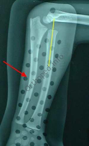 Fracture plastique de l'ulna associée à une luxation de la tête radiale (Fracture de Monteggia)