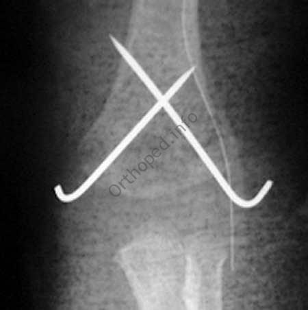 Fracture supra-condylienne - Outi