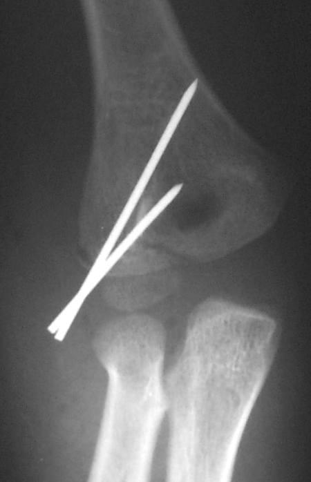 Fracture du condyle latéral du coude - Outi