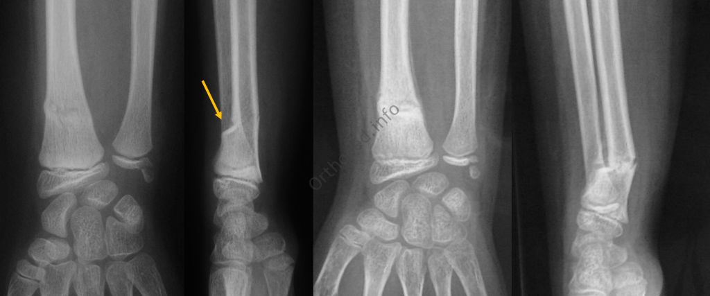 Fracture En Motte De Beurre Outi fracture-en-motte-de-beurre-outi