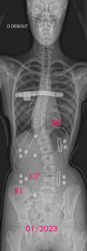 Scoliose idiopathique - VBT -1 - pré-op