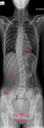 Scoliose idiopathique - VBT -1 - pré-op en traction