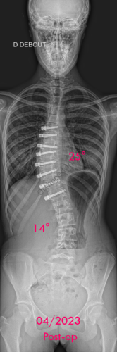 Scoliose idiopathique - VBT -1 - post-op immédiat