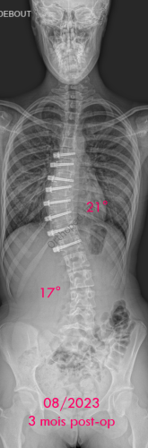Scoliose idiopathique - VBT -1 - 3 mois post-op