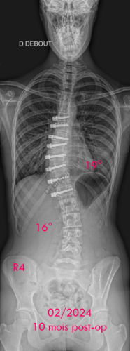 Scoliose idiopathique - VBT -1 - 10 mois post-op