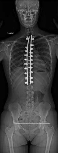 Radiographie de Face à 3 mois post-opératoire
