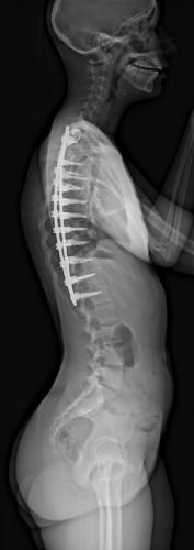 Radiographie de Profil à 3 mois post-opératoire