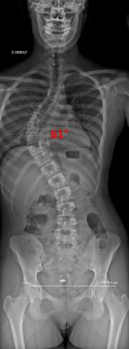 Radiographie pré-opératoire de Face