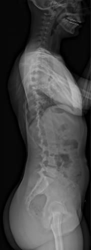 Radiographie pré-opératoire de Profil