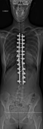 Radio à 1 an de recul de Face