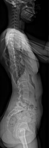 Radio pré-opératoire de Profil