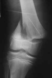 Salter 2 fémur distal - 1