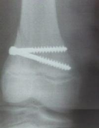 Fracture Salter 2 : après ostéosynthèse par vis