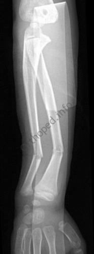 Fracture en bois vert avant-bras : Radio initiale de Face