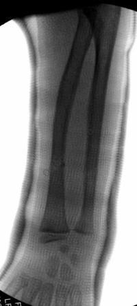 Fracture en bois vert avant-bras : Radio de Face après réduction