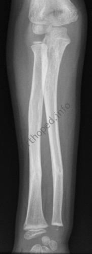 Fracture en bois vert avant-bras : Radio de Face à 3 mois