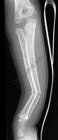 Fracture en bois vert avant-bras : Radio initiale de profil