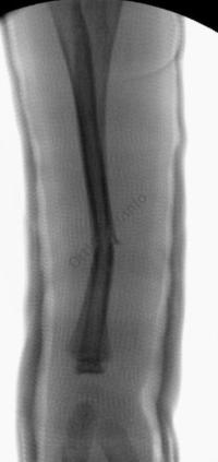 Fracture en bois vert avant-bras : Radio de Profil après réduction