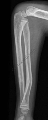 Fracture en bois vert avant-bras : Radio de Profil à 3 mois