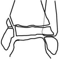 Fracture Salter 4 de l'extrémité distale du tibia