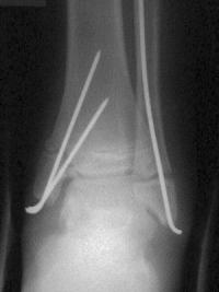 Fracture Salter 4 du tibia distal