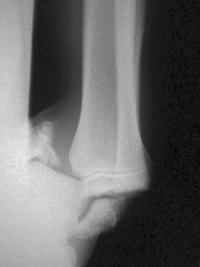 Fracture Salter 4 du tibia distal