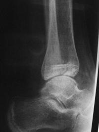 Fracture Salter 4 du tibia distal