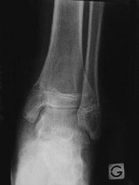 Fracture Salter 4 du tibia distal