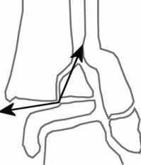 Fracture Salter 2 de l'extrémité distale du tibia