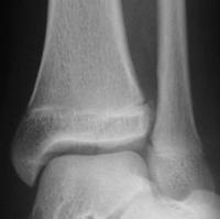 Salter 3 tibia distal -1