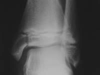Fracture Salter 4 de l'extrémité distale du tibia