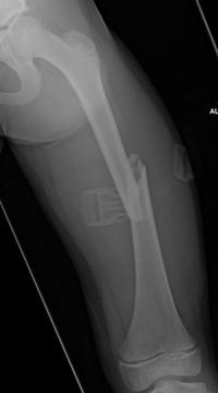 Fracture diaphysaire du fémur G
