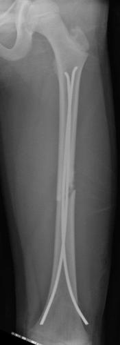 Fracture diaphysaire du fémur G