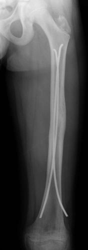 Fracture diaphysaire du fémur G