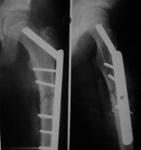 Fracture fémur proximal traitée par clou-plaque