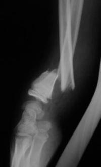 Métaphyse poignet -1 Radio initiale Profil