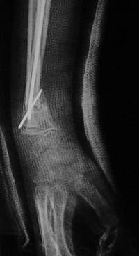 Métaphyse poignet -1 Radio post-opératoire Profil