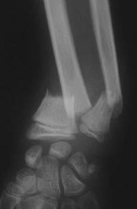 Métaphyse poignet -1 Radio initiale Face