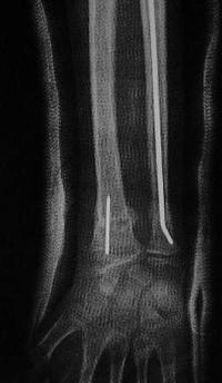 Métaphyse poignet -1 Radio post-opératoire Face