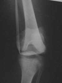 Salter 1 fémur distal