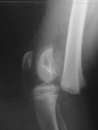 Salter 1 fémur distal